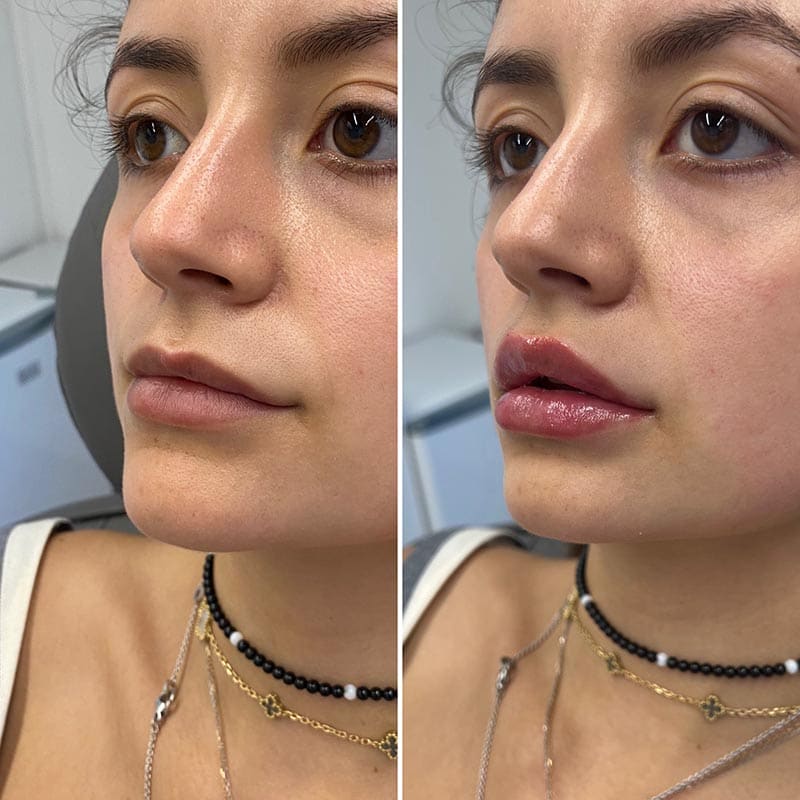 PlumpPerfection™ Lip Booster