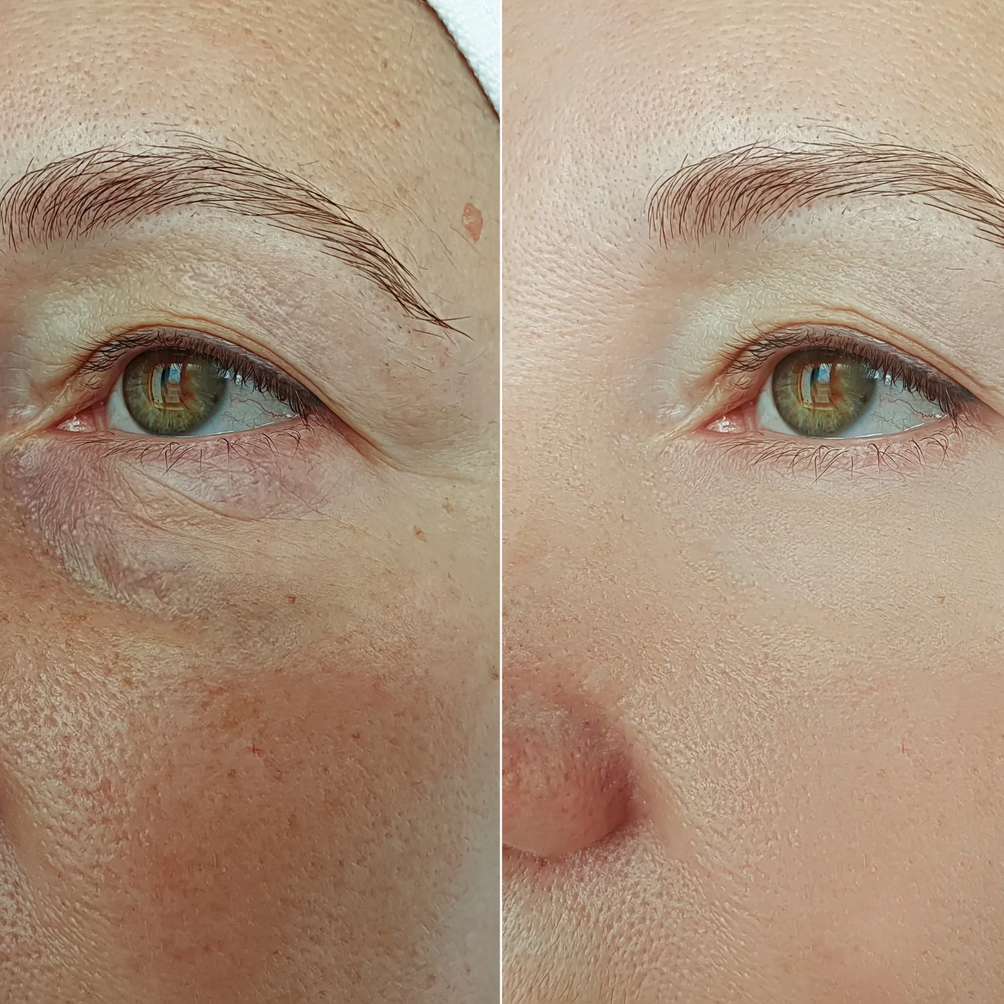 PoreErase™ Blackhead Remover