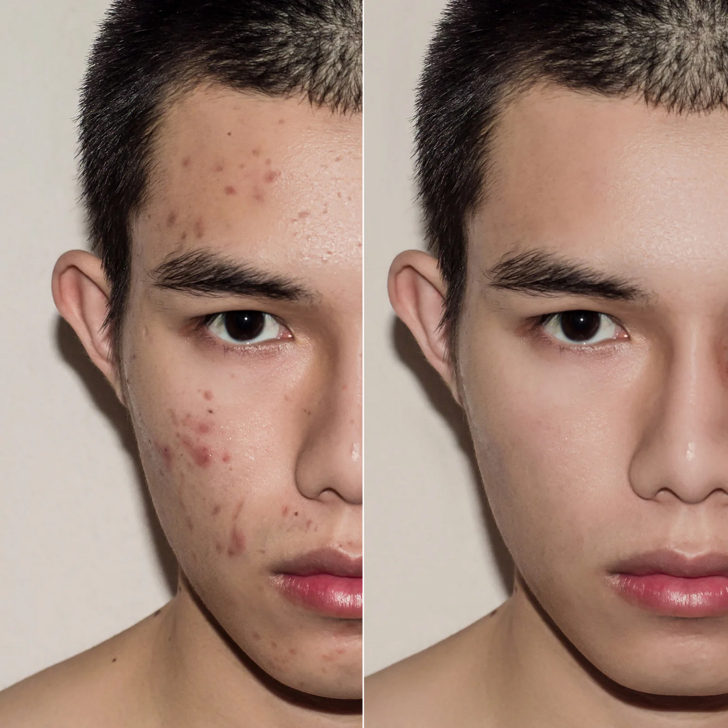 PoreErase™ Blackhead Remover