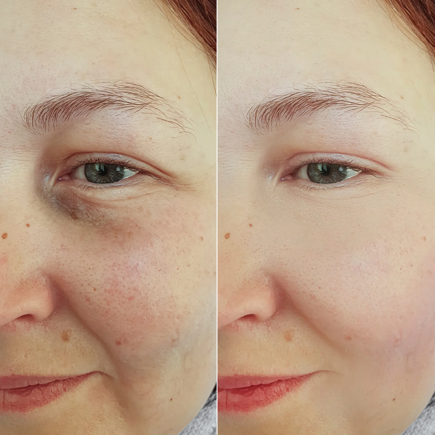 PoreErase™ Blackhead Remover